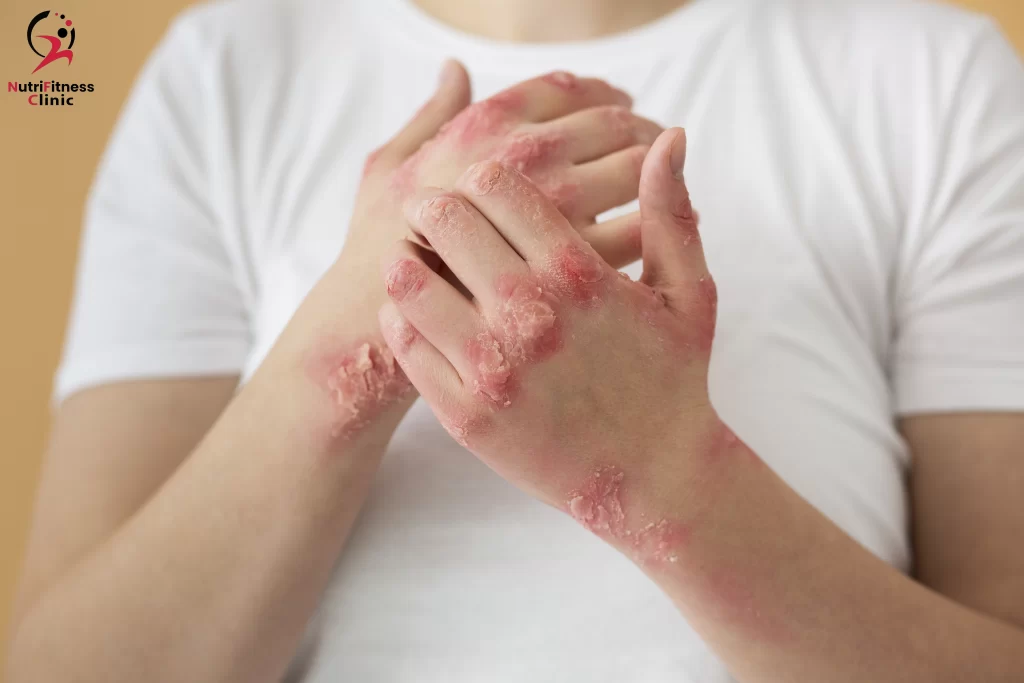 خطة غذائية لمرضى الصدفية