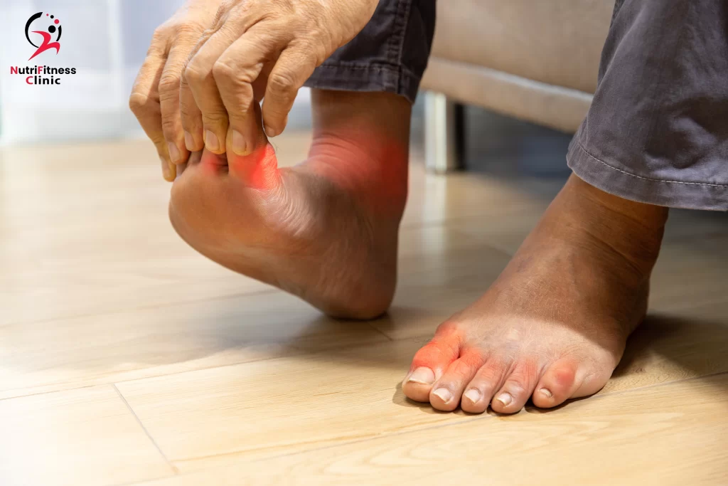 خطة غذائية لمرضى النقرس