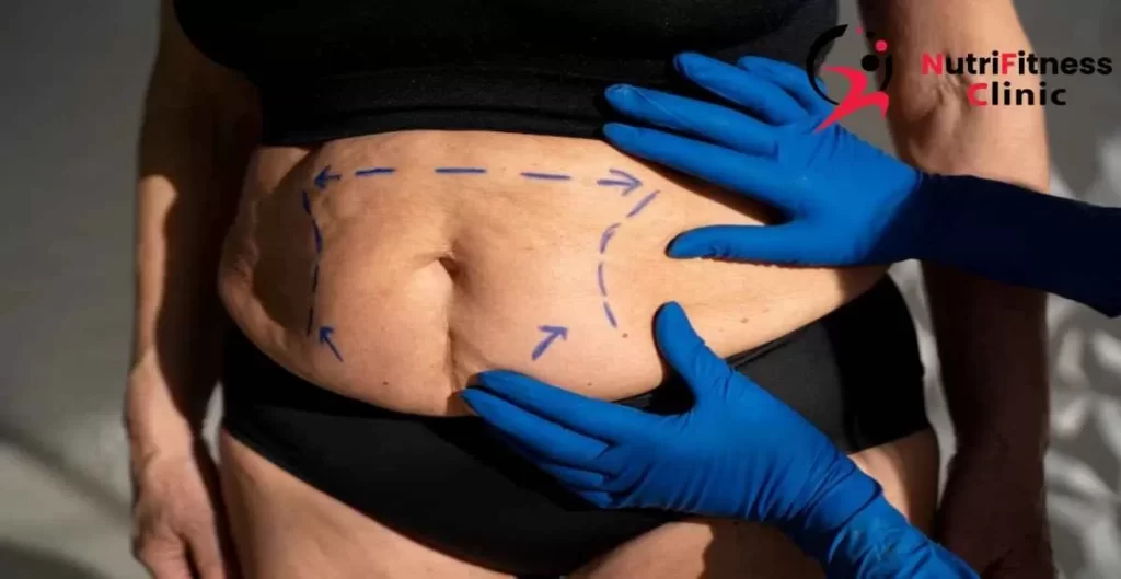 أفضل جلسات لشد ترهلات الجسم والبطن مجربة بدون جراحة